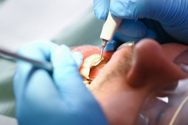 Best Emergency Tooth Extraction in Ansonia, OH