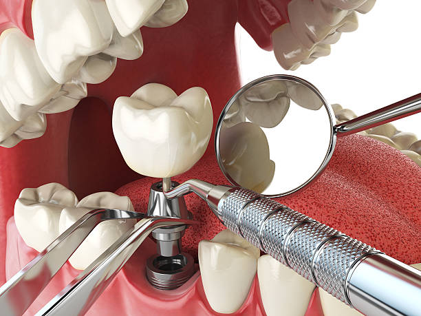 Best Emergency Wisdom Teeth Removal in Ansonia, OH
